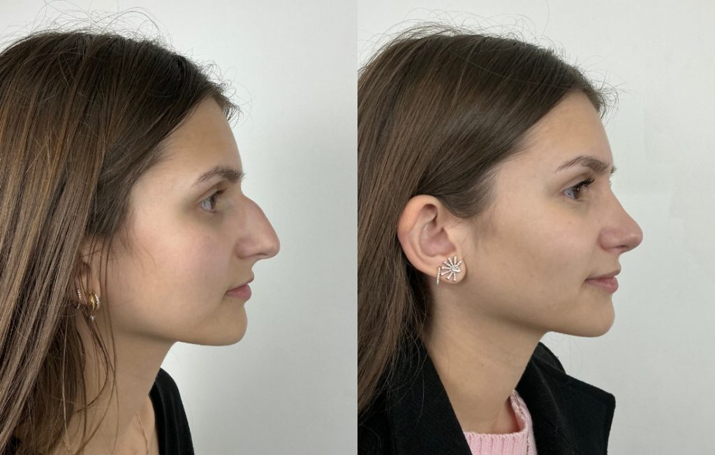 Rinoplastia antes e depois perfil feminino Lisboa