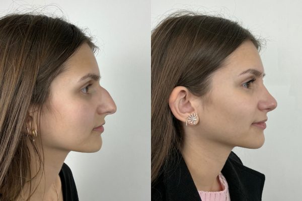 Rinoplastia antes e depois perfil feminino Lisboa