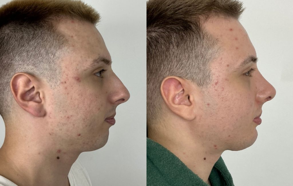 Rinoplastia masculina resultado natural perfil Lisboa