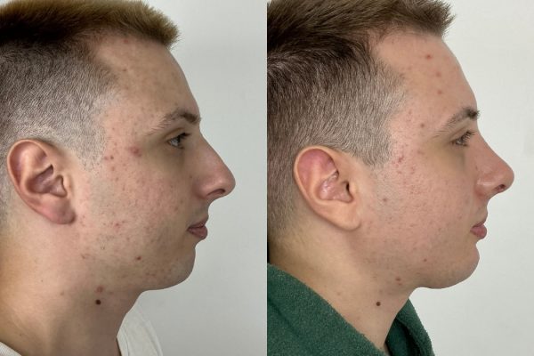 Rinoplastia masculina resultado natural perfil Lisboa
