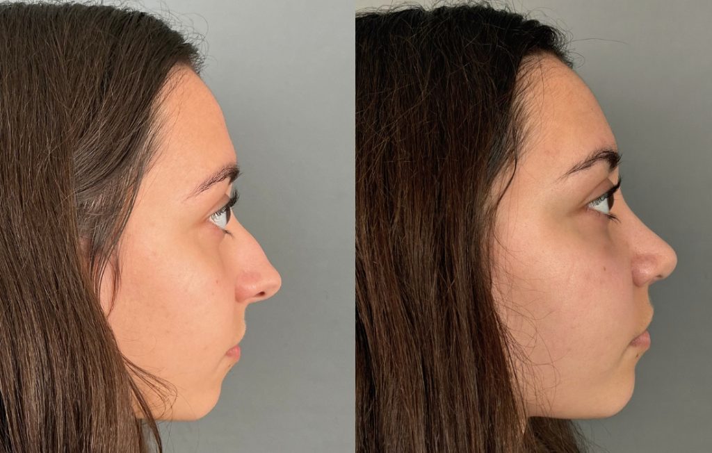 Rinoplastia feminina resultado natural vista lateral Porto