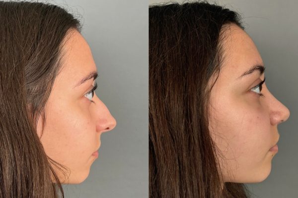 Rinoplastia feminina resultado natural vista lateral Porto