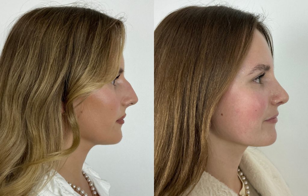 Rinoplastia antes e depois paciente feminina perfil natural Porto