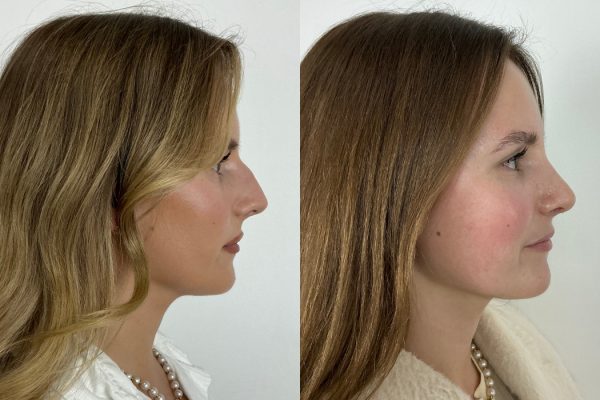 Rinoplastia antes e depois paciente feminina perfil natural Porto