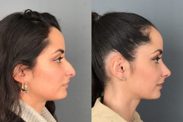 Rinoplastia Porto cirurgia estética