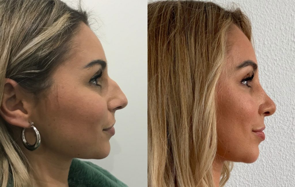 Rinoplastia de frente Porto cirurgia estética