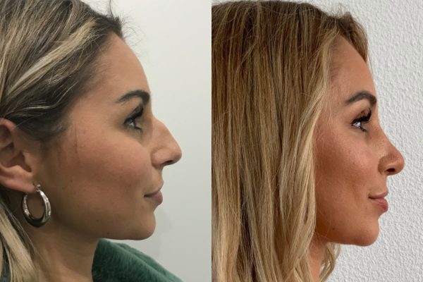 Rinoplastia de frente Porto cirurgia estética