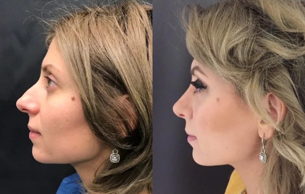 Rinoplastia Agens Arabela cirurgia