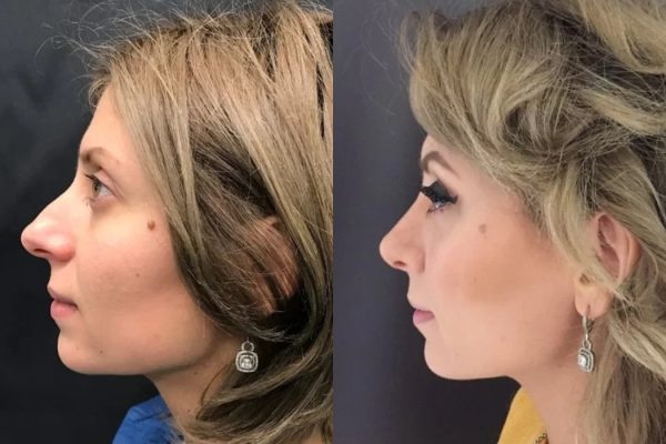 Rinoplastia Agens Arabela cirurgia