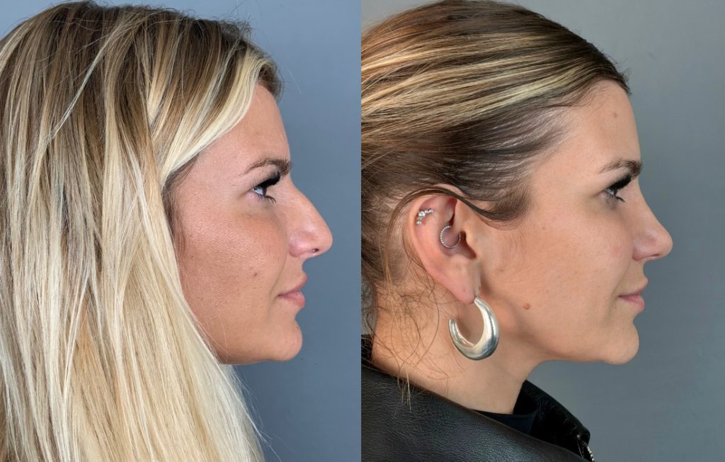 Rinoplastia Cristiana Jesus cirurgia plástica estética