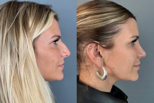 Rinoplastia Cristiana Jesus cirurgia plástica estética