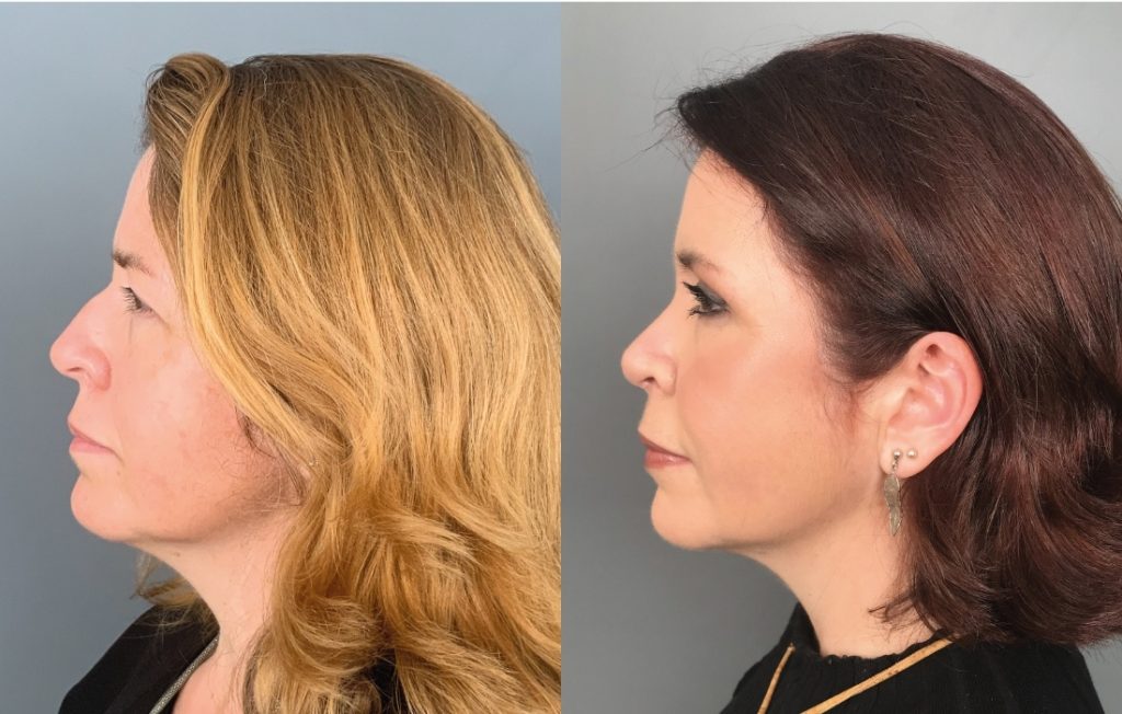 Rinoplastia Lisboa mudança de visual