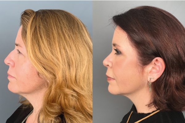 Rinoplastia Lisboa mudança de visual