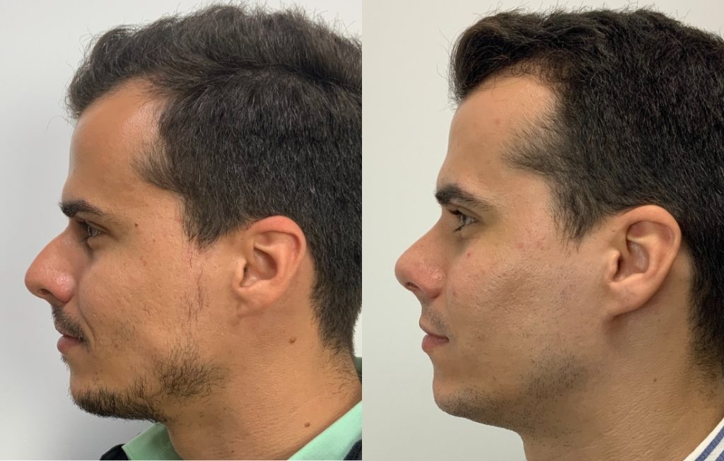 Rinoplastia homem masculino de lado Lisboa