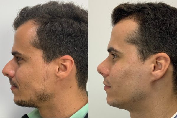 Rinoplastia homem masculino de lado Lisboa
