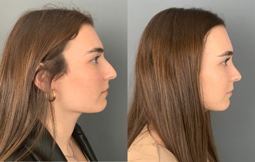 Rinoplastia feminino lado Lisboa