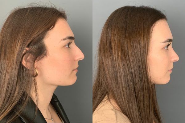 Rinoplastia feminino lado Lisboa