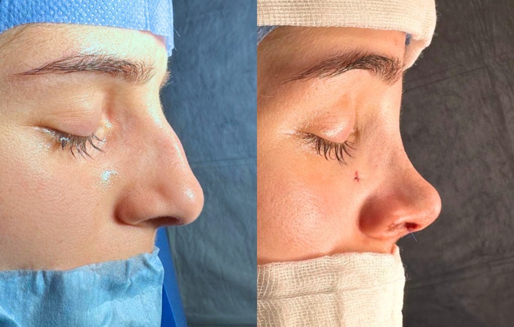Rinoplastia pós-operatório resultado Lisboa