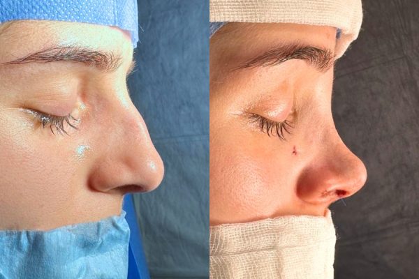 Rinoplastia pós-operatório resultado Lisboa