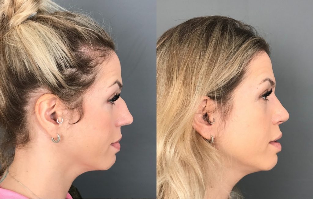 Rinoplastia feminino lado Lisboa estética
