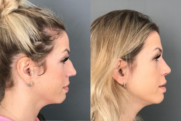 Rinoplastia feminino lado Lisboa estética