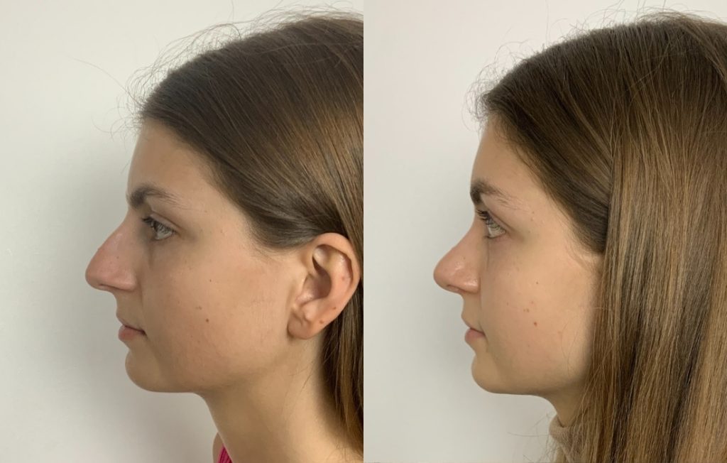 Rinoplastia feminino lado Porto