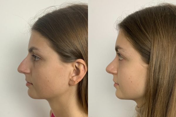 Rinoplastia feminino lado Porto