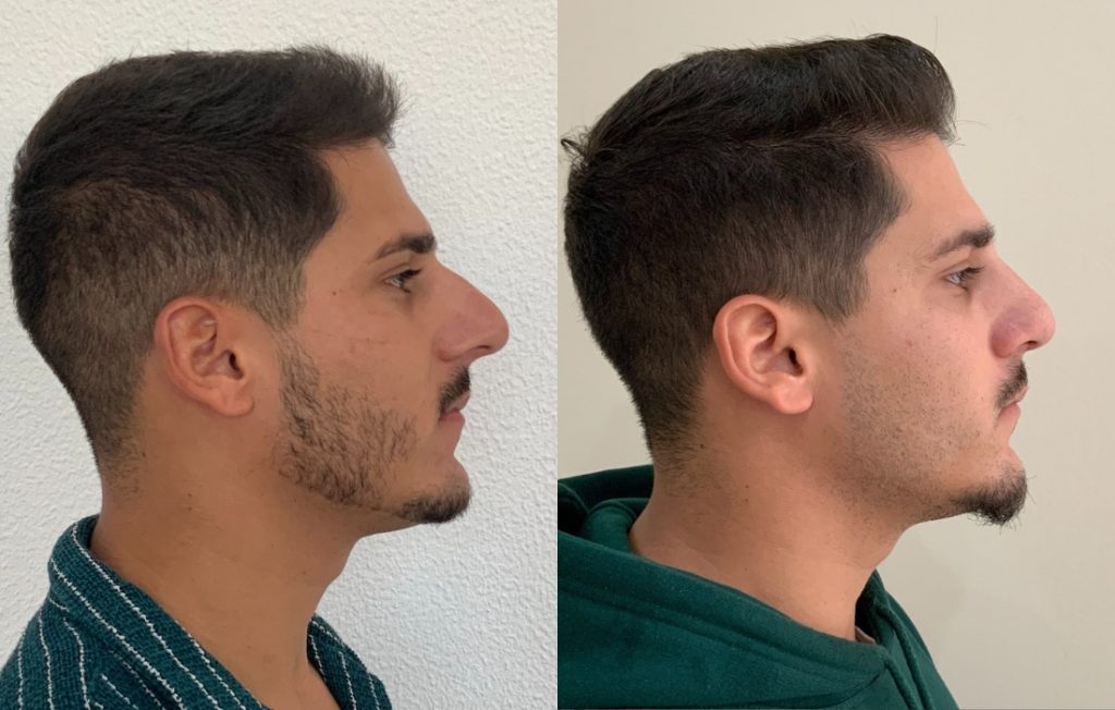 Rinoplastia homem masculino de lado Porto