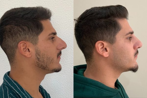 Rinoplastia homem masculino de lado Porto