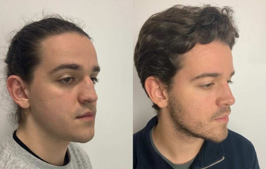 Rinoplastia homem masculino de lado Lisboa estética