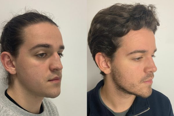 Rinoplastia homem masculino de lado Lisboa estética