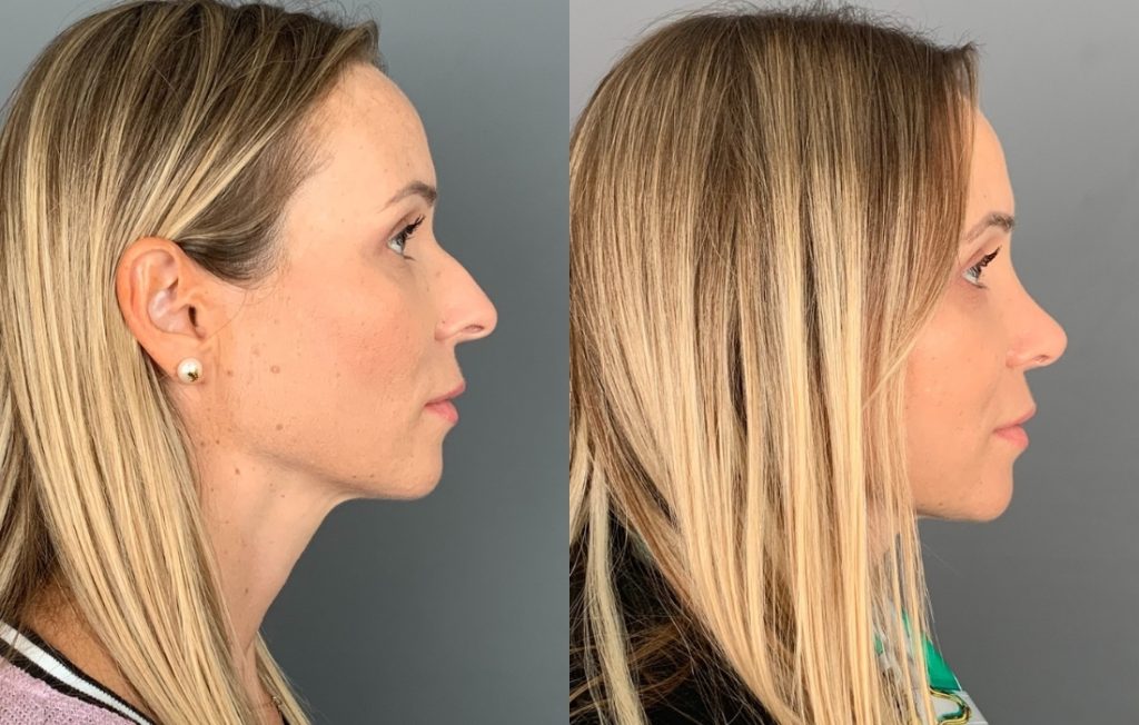 Estética rinoplastia feminino Lisboa