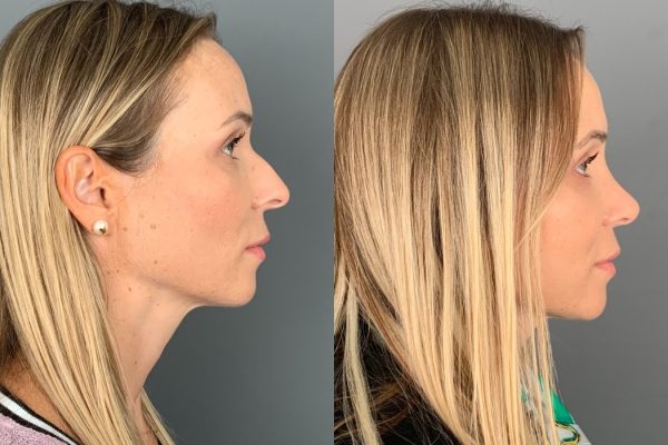 Estética rinoplastia feminino Lisboa