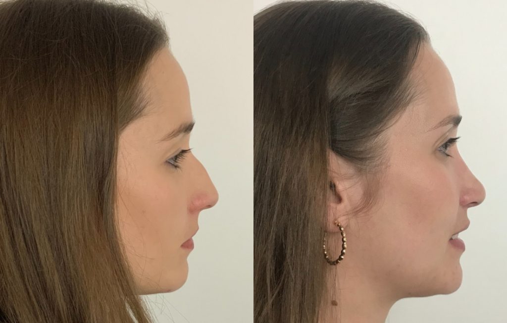 Estética rinoplastia feminino Porto