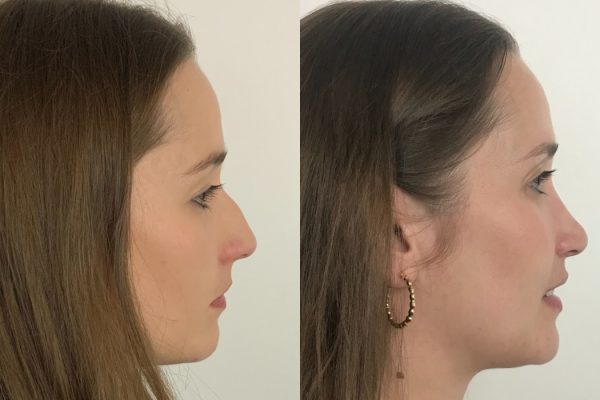 Estética rinoplastia feminino Porto