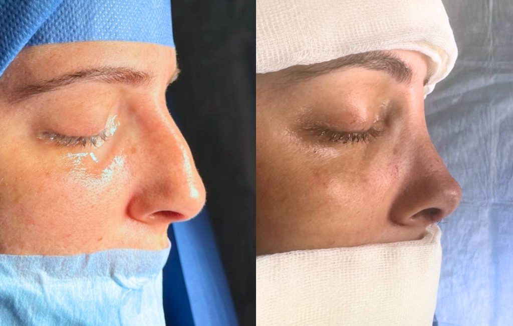 Rinoplastia homem pós-operatório