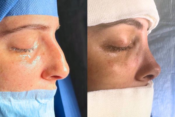 Rinoplastia homem pós-operatório