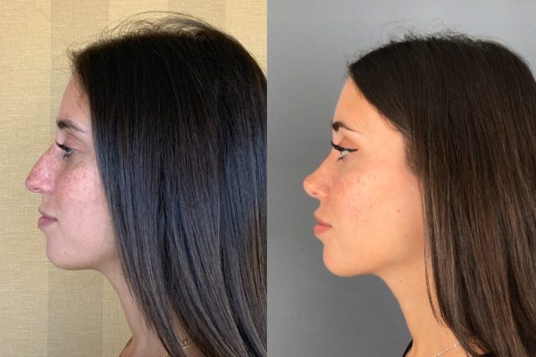 Rinosseptoplastia feminino de lado natural Lisboa