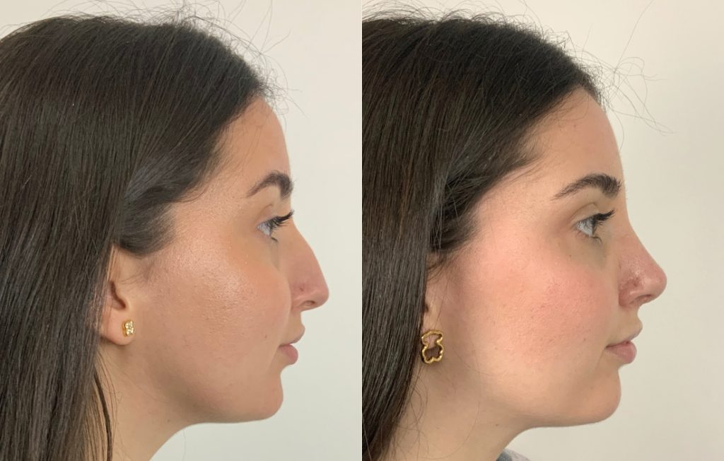 Rinoplastia antes e depois paciente feminina perfil natural Lisboa
