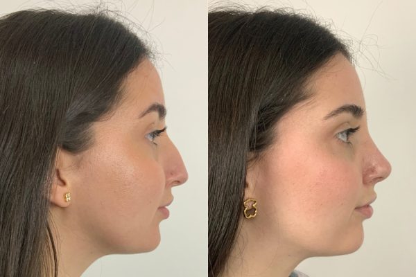 Rinoplastia antes e depois paciente feminina perfil natural Lisboa